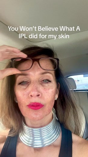 IPL Treatment for Freckles: My Before & After Results