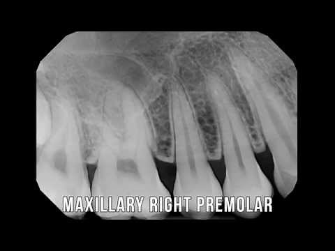 X-Ray lesson series: 1 - Full Mouth X rays