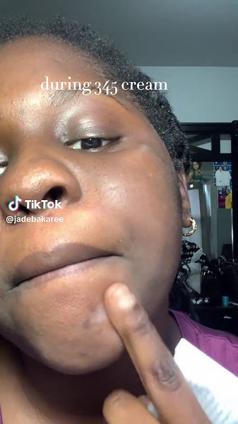 Best Acne Treatment Products for Prone Skin