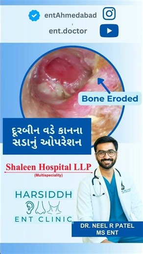 🎥 Endoscopic Cholesteatoma Surgery | Dr. Neel R Patel MS ENT #drneelpatel