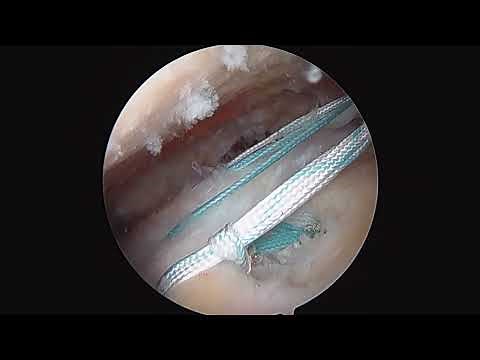 Full-thickness rotator cuff (supraspinatus) repair by Dr. Andrew Dold, MD
