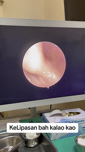 Cockroach in Ear..#mrikramhakim #entsurgeon #fyp #fypシ #foreignbodyear