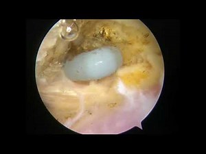 Arthroscopic full posterior vision distal clavicle resection