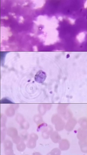 Malaria under the microscope 🔬 | Ring forms & banana-shaped gametocyte of Plasmodium