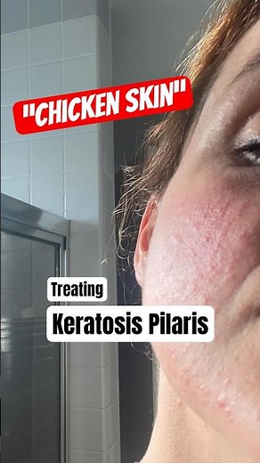 How to treat Keratosis Pilaris