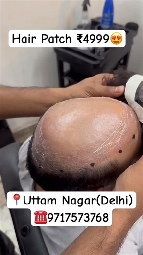 Trendz Hair Wigs | Hair Patch Fixing ₹4999🌹 #hairpatch #nonsurgicalsolutions #wigs #hair #hairwigs | Instagram