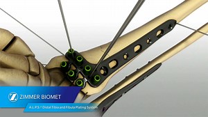 A.L.P.S.® Distal Tibia and Fibula Plating System