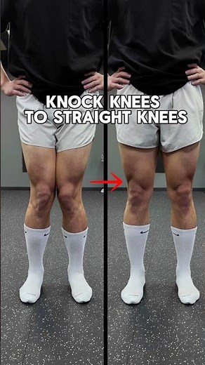 Leg Shape: Knock Knees to Straight Knees
