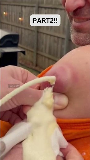 🔥Deep Blackheads, Milia & Whitehead Removal pimple popping New| Big Cystic Acne Extraction