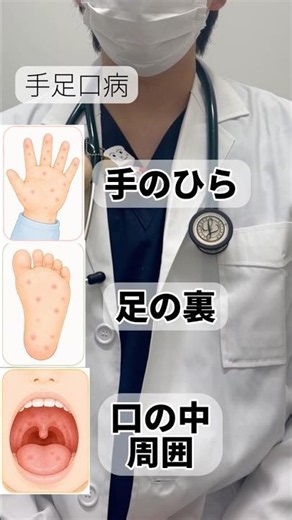 手足口病って薬で治らない？ #小児科 #保育園