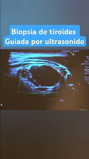 ULTRASOUND GUIDED THYROID BIOPSY