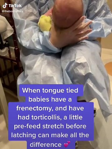 Improving Infant Feeding with Frenectomy and Torticollis Treatment