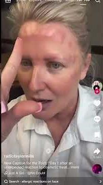 Please Help Me. Why Is My Forehead Red and Bumpy and Bruised Lip After Cosmetic Injections