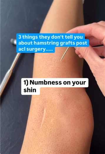 Key Insights on Hamstring Grafts After ACL Surgery