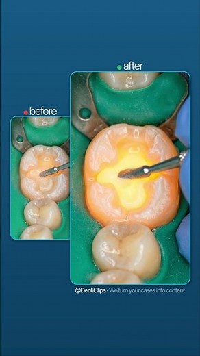Old Filling Removed — The Decay Underneath Will Shock You | Full Composite Restoration