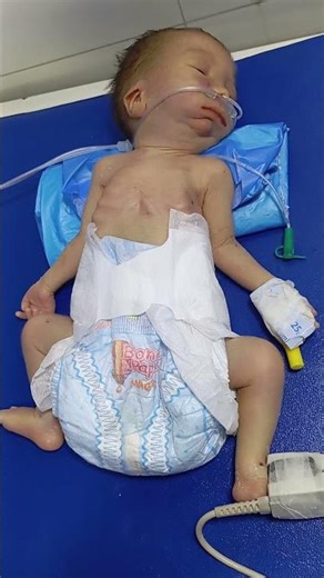 pressies baby and respiratory distress