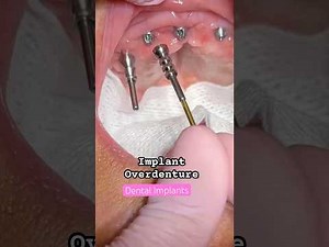 IMPLANTS OVERDENTURE