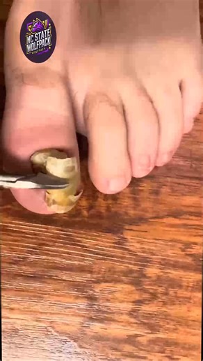 86K views · 317 reactions | Safe Nail Cleaning for Callused Toes with Gentle Fresh Steps #SimpleNailCare #HealthyNails #ToenailRoutine | NC State Wolfpack on TheWolfpacker.com | Facebook