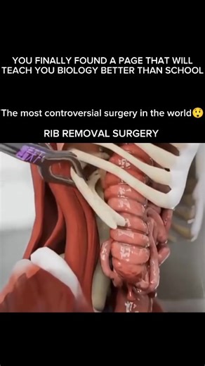 Explaining Biology on Instagram: "Rib removal” is a major surgical procedure where the lower floating ribs (usually the 11th and 12th) are removed. These ribs protect important organs like your kidneys, spleen, and liver, which is why the surgery is rarely done for cosmetic reasons. Many people online talk about rib removal for a “tiny waist,” but in reality, it’s a high-risk surgery most surgeons do not recommend for body shaping. ❗ Harmful Effects & Risks Rib removal can lead to serious compli