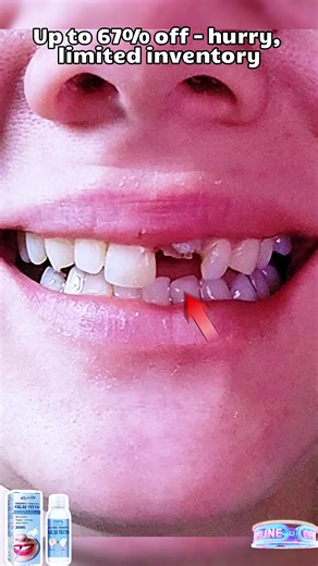 A quick three-step solution for a missing front tooth.