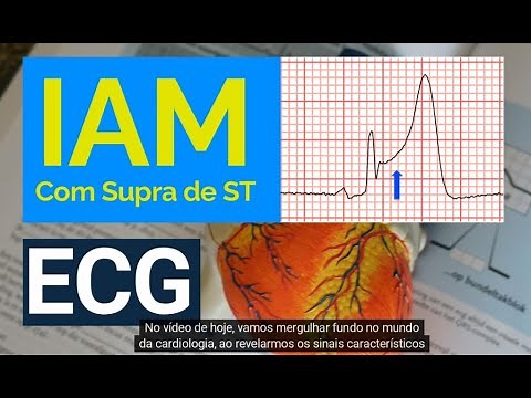 IAM com SST: Dominando a Detecção de Infarto do Miocárdio com Supradesnivelamento do ST no ECG.