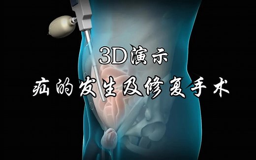 3D演示疝的发病机制及疝修复术