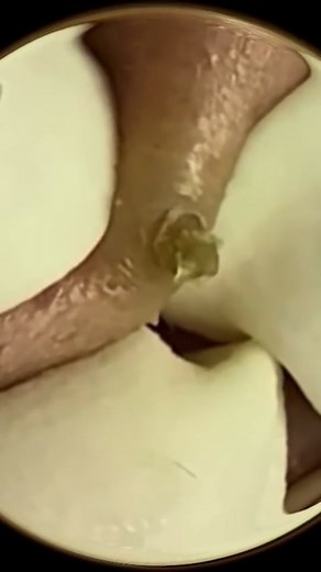 Video di the pimple crusher (@the.pimple.crusher) con Flowers - Miley Cyrus