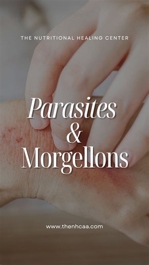 🌿 Struggling with Morgellons disease? This is not just a skin condition; it's a complex health challenge that demands a comprehensive approach. 👩‍⚕️ After 30 years in holistic healthcare, we've developed the 7 Step Blueprint to Optimal Health. Recently, a patient with Morgellons saw incredible progress through this program. Despite earlier setbacks, including visible parasites, our holistic approach finally brought relief after addressing Lyme disease in the final step. 🔍 Morgellons isn't jus