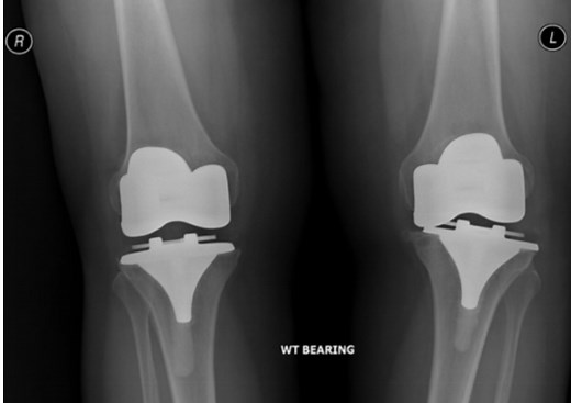 Failed Total Knee Replacements