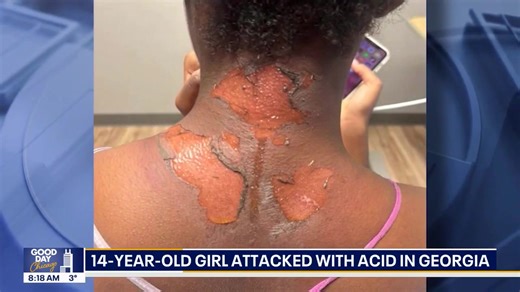 Teen Faces Severe Chemical Burn from Bullying Incident