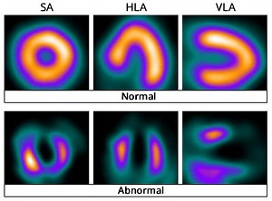 Cardiac Nuclear Stress Test in Manhattan, New York City