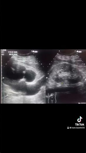 Hydronephrosis and hydroureter in kidney and ureter