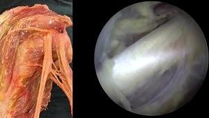 Endoscopic Hamstring Repair