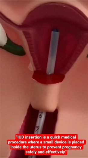 "IUD Insertion Explained | Safe Birth Control Method (Educational 3D Animation)" #healtheducation