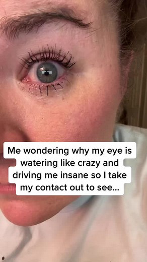 Contact Lens Mishap at 3:45 AM