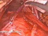 Collis Gastroplasty and Hiatoplasty for Short Esophagus after Bariatric Surgery • Video • MEDtube.net