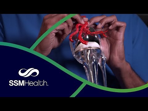 Genicular Artery Embolization to Treat Osteoarthritis