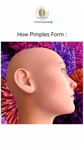 How Everything Works on Instagram: "Follow @theexplainzone For More Explain 🧠 A pimple forms when a hair follicle (pore) gets clogged with excess oil, dead skin cells, and bacteria. Your skin naturally produces oil, called sebum, to keep it soft and protected. But when too much sebum is produced, it can mix with dead skin cells and block the pore. Inside this clogged pore, bacteria — especially Cutibacterium acnes (formerly called Propionibacterium acnes) — begin to grow. Your immune system rea