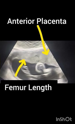 Pregnancy Ultrasound showing Placenta Position! Anterior Placenta! Femur length#ultrasoundmadeeasy86