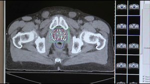 FDA approves 'game-changing' prostate cancer tool