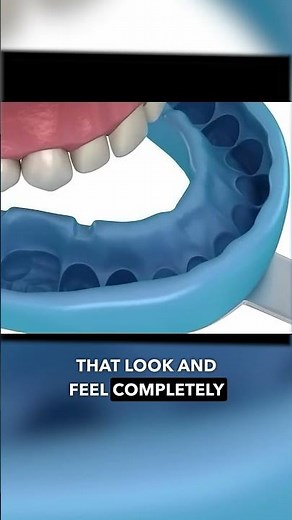 How Veneers Are Done