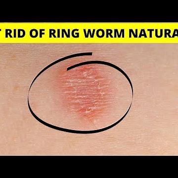 How to get rid of ring worm naturally fast and permanently at home