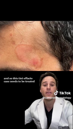 Medical Derm Monday with Dr. Cameron | Tinea Faciei 💥 Tinea Faciei is rare and similar to ringworm, but this occurs on the face. May look like eczema or psoriasis which may get wrongly treated with topical steroids, but needs to be treated with oral anti fungals for a few weeks in order to heal. #nyc #manhattan #newyorkcity #dermatology #dermatologist #tineafaciei #medicaldermonday #camerondermatology