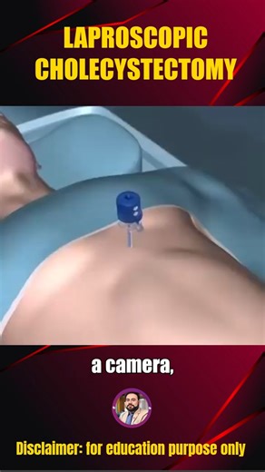 Gallbladder Removal in 60 Seconds | Laparoscopic Cholecystectomy 3D #shorts