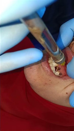 anathesia for upper lateral extraction