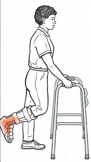 Non-Weight Bearing? Walk SAFELY with This Walker Trick! 🧠✅