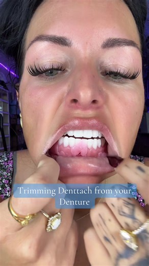 Trimming Denttach for Better Denture Fit