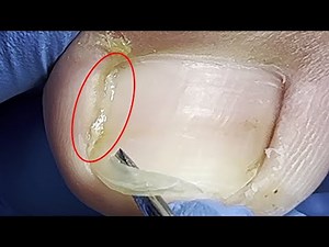 A small amount of pus leaked from one side of the toenail, disinfected and trimmed【Xue Yidao】