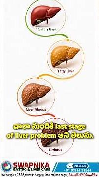 5 Warning Signs of Advanced Liver Damage You Must Know | Cirrhosis Explained