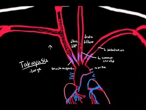 Takayasu Arteritis
